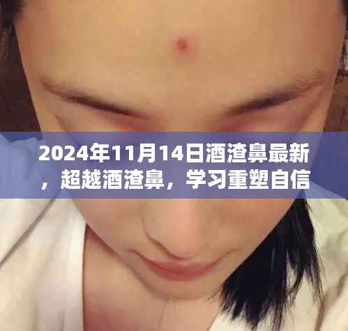 超越酒渣鼻,重塑自信,笑迎人生挑战的最新指南(2024年11月14日)