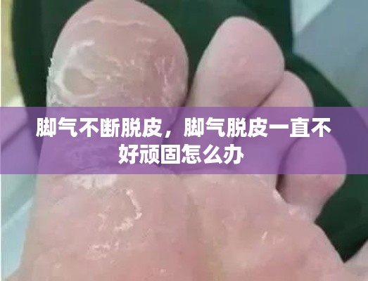 脚气不断脱皮,脚气脱皮一直不好顽固怎么办
