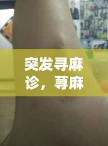 突发寻麻诊,荨麻诊出现的原因